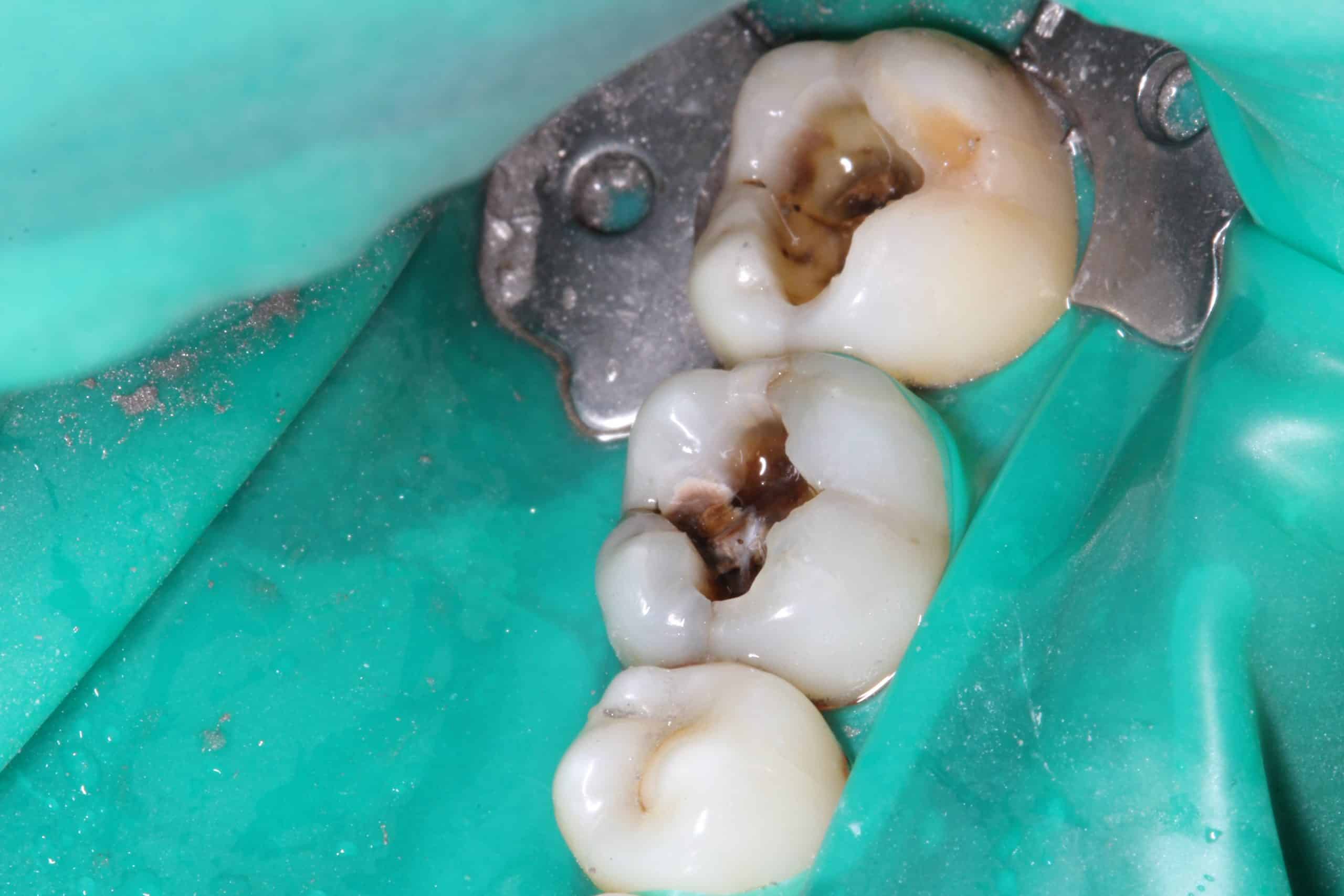 Dental filling Hervey Bay