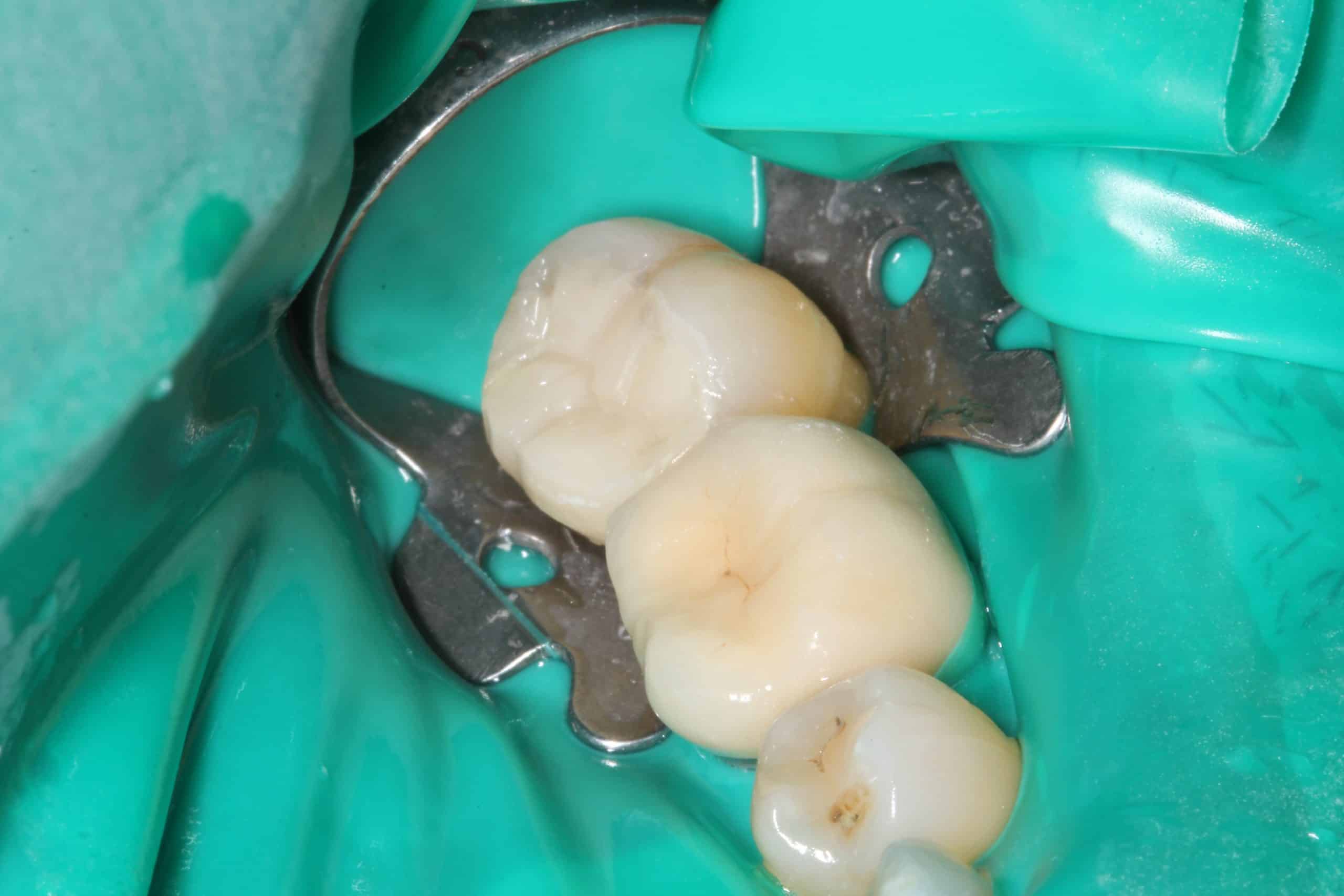 White tooth filling - match color filling