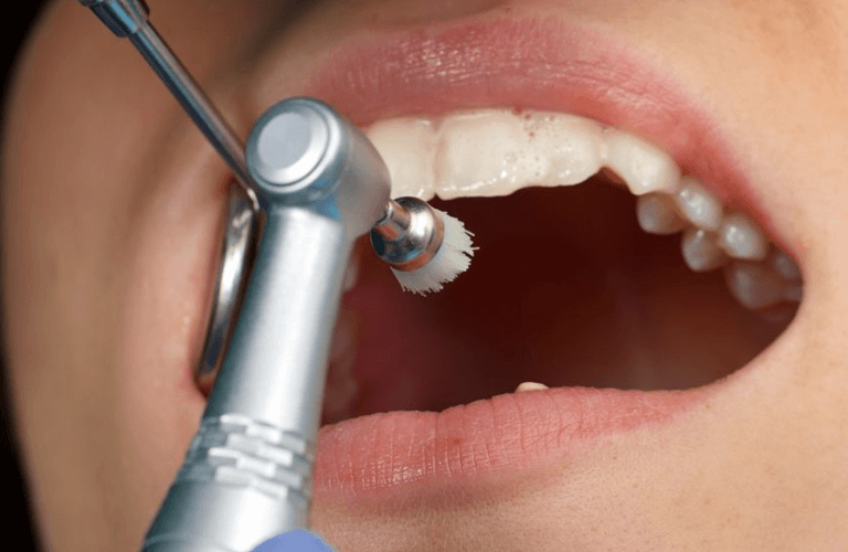 Oral cleaning Hervey Bay