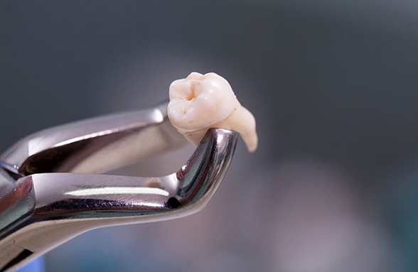 Teeth Extractions Dentist Hervey Bay