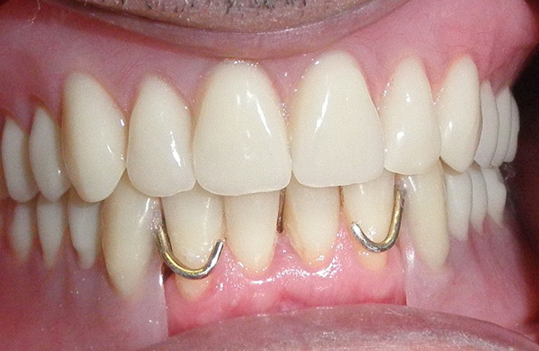 Dentures Clinic Hervey Bay | Best Dental Clinic