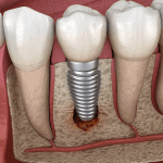 Dental implants | Periodontics Services in Hervey Bay