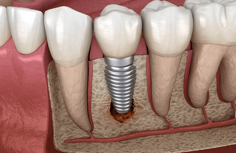 Dental implants | Periodontics Services in Hervey Bay