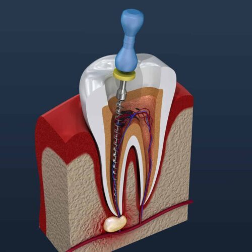Wide Bay Central Dental - Root Canal Treatment