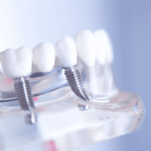 multiple Dental implants hervey bay