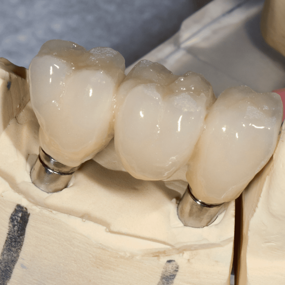 multiple Dental implants hervey bay