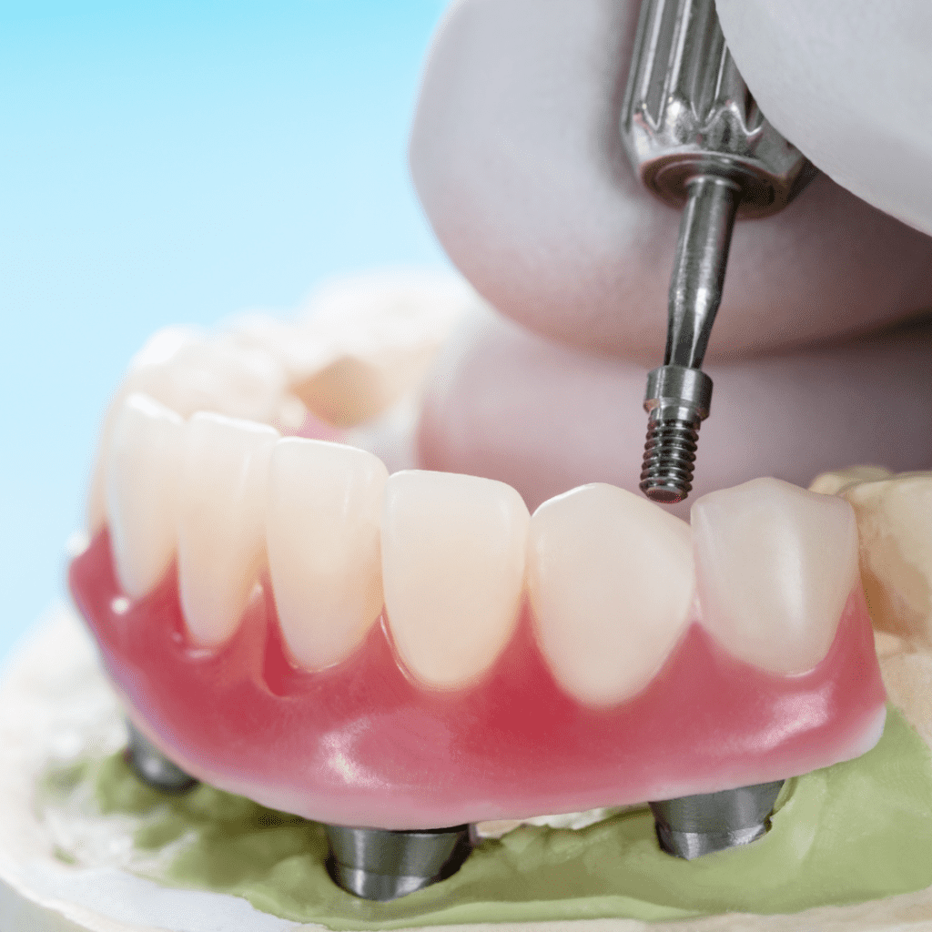 Prosthodontist Hervey bay - Dr Ash