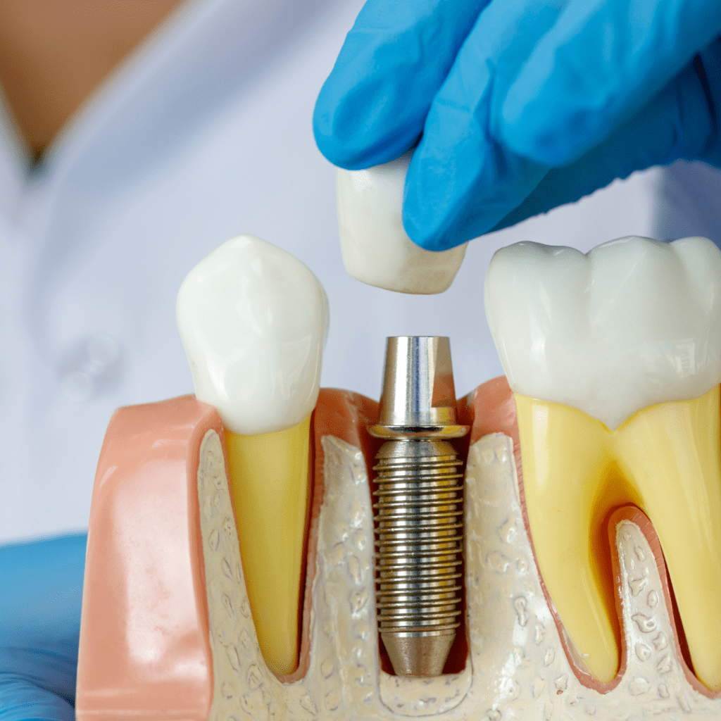 Single dental implant Hervey bay