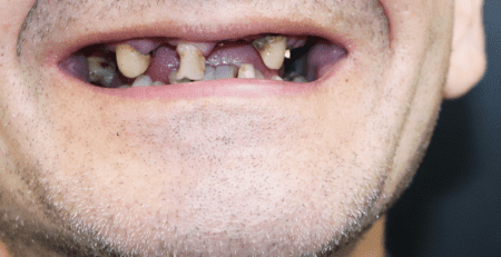 Teeth loss - dentures and dental implants