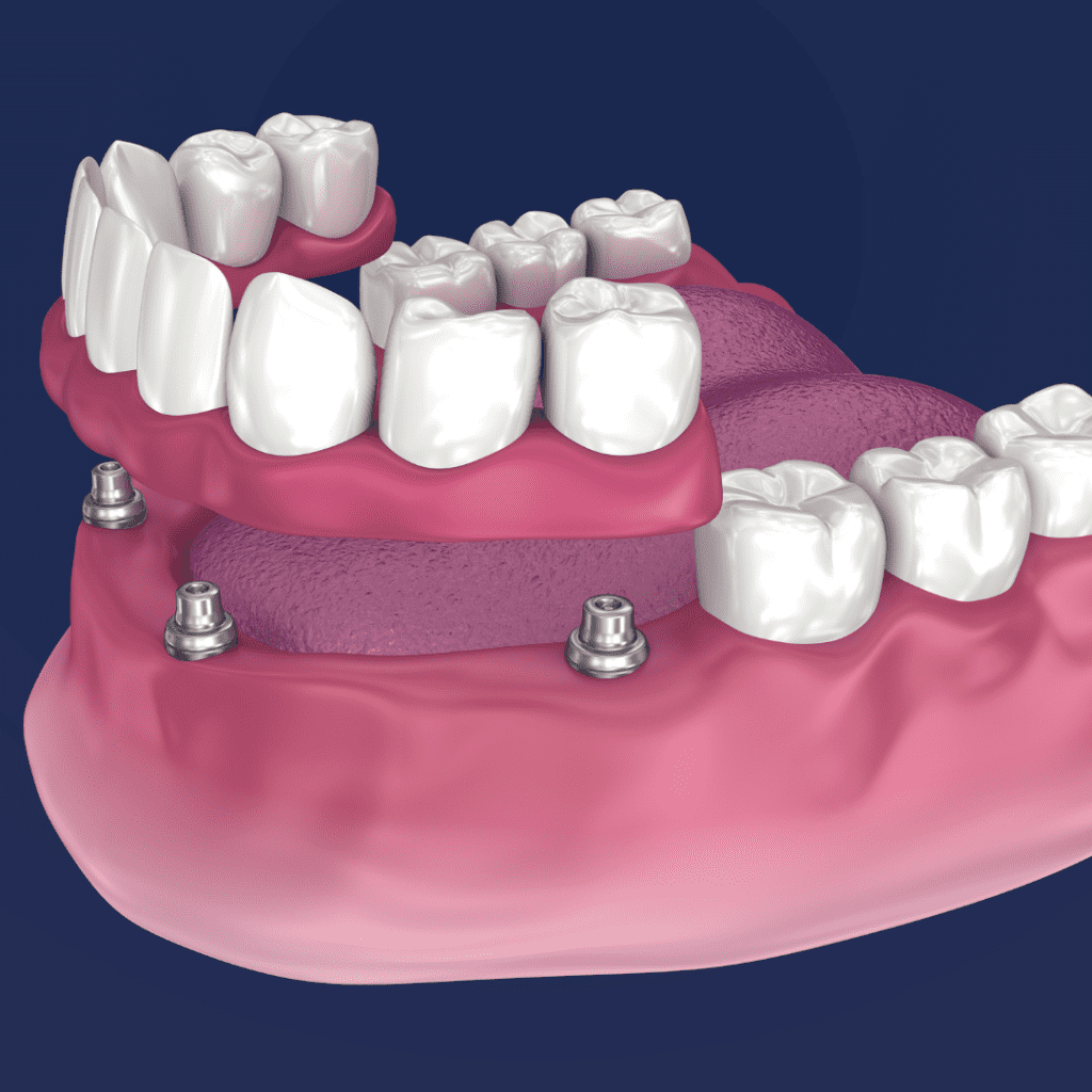 denture supported implant