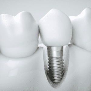 single Dental implants hervey bay