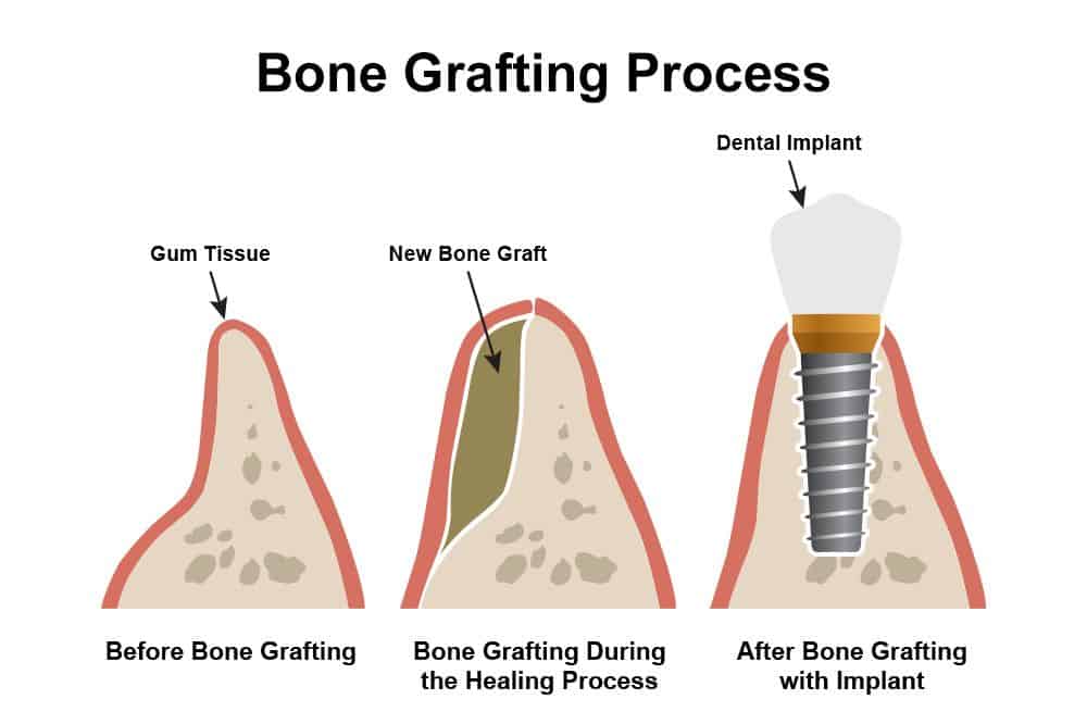 Bone_Grafting_Process- Hervey bay