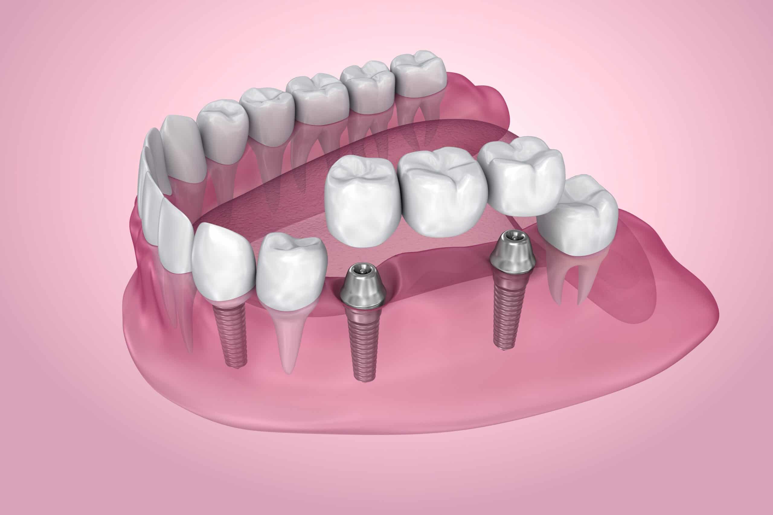 Dental implant Bridges Hervey bay