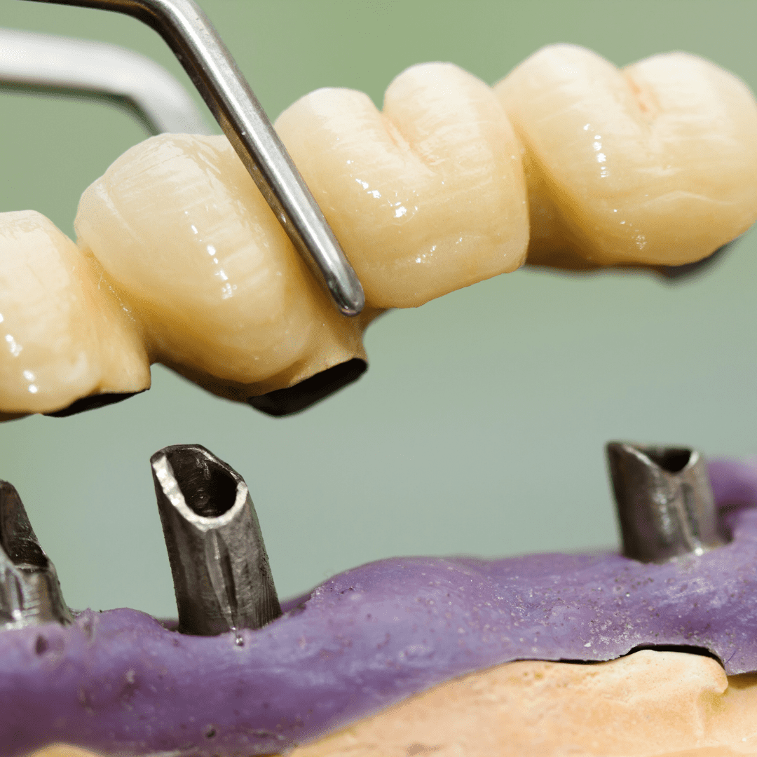 Dental crowns and Bridges treatment in Hervey Bay