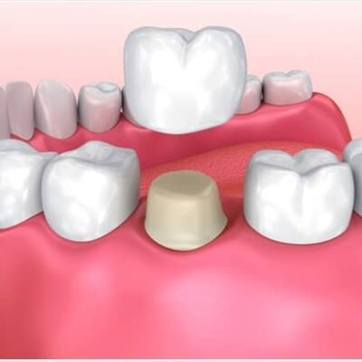 best Dental crowns Hervey bay