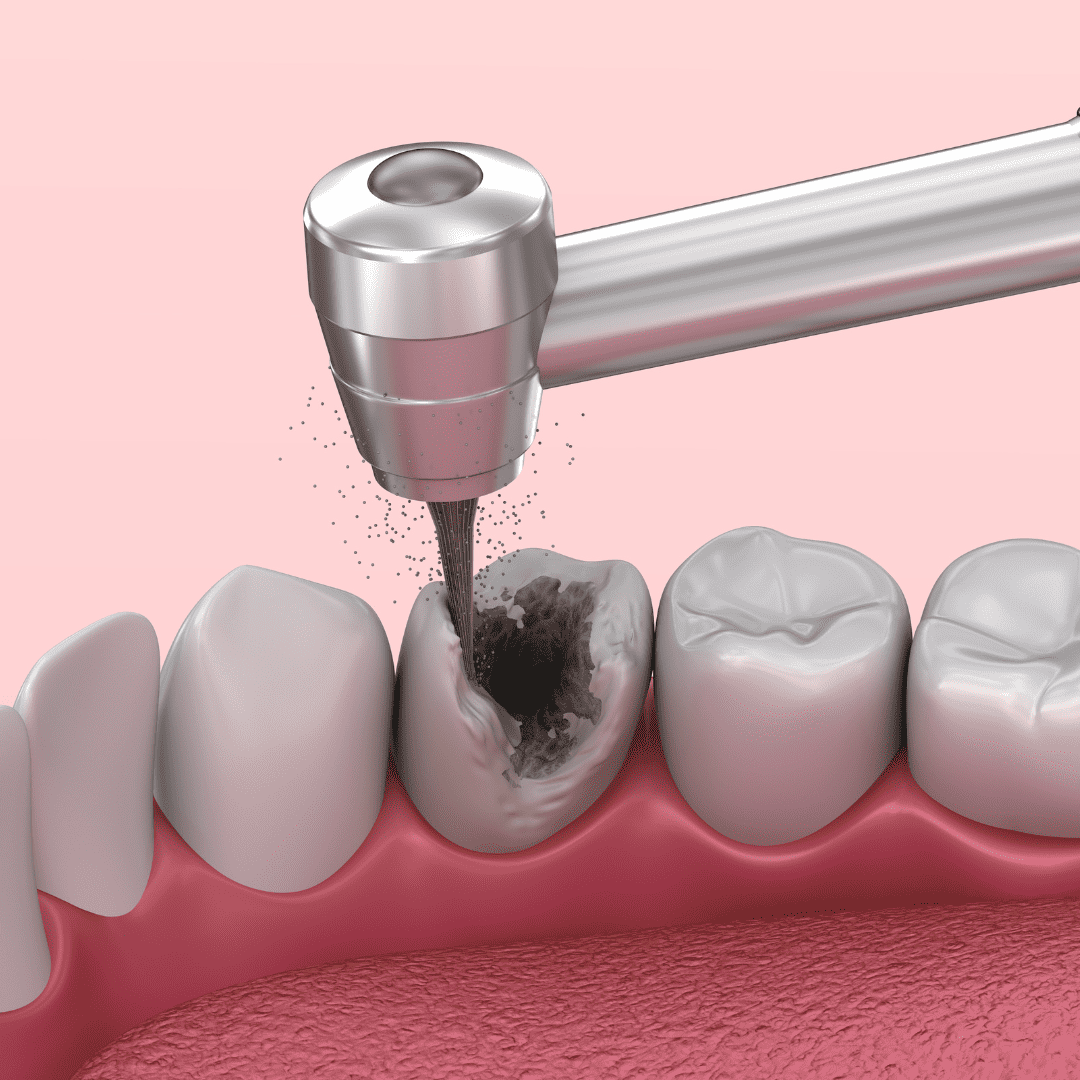 Tooth decay repair hervey bay