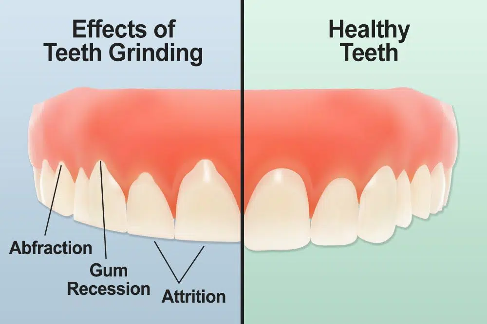 teeth grinding treatment Hervey bay