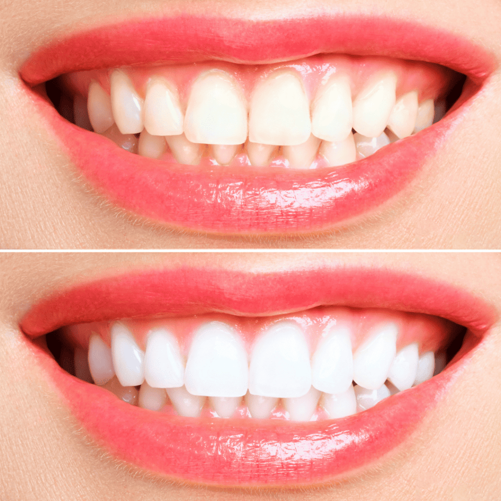 teeth whitening hervey bay
