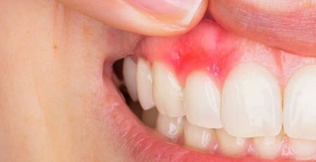 Dental Abscess treatment in Hervey bay - Same day emergency appointment