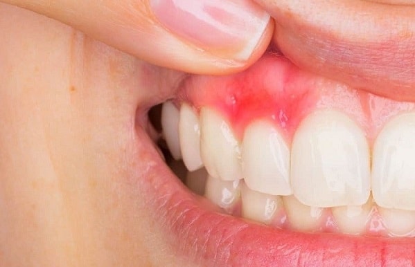 Dental Abscess treatment in Hervey bay - Same day emergency appointment