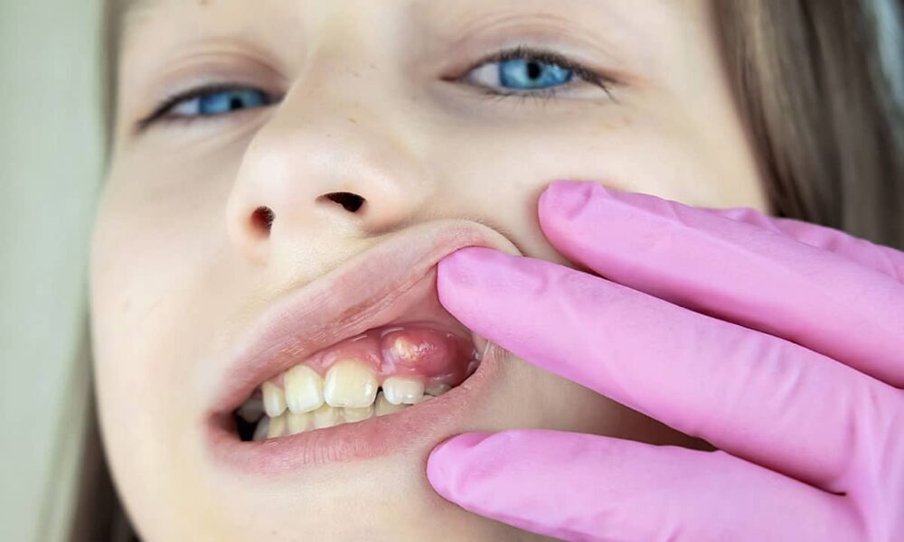 Dental Abscess treatment in Hervey bay - Same day emergency appointment children