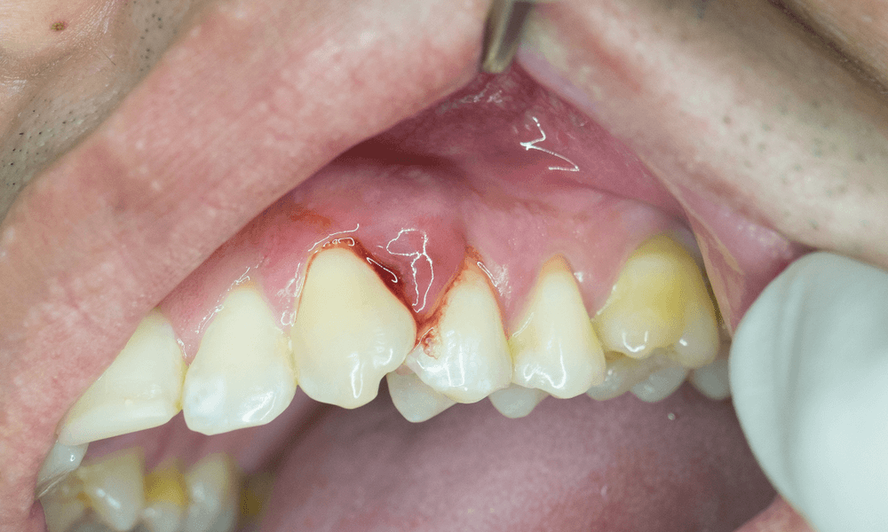 Dental Abscess treatment in Hervey bay - Same day emergency appointment qld